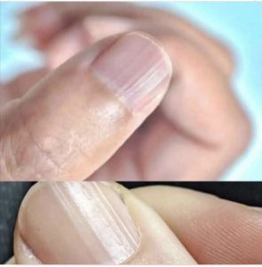 HAVING Striped Nails Could Mean That Your Body Is…. See more